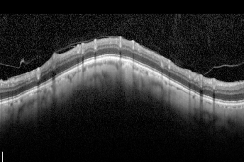 Optic Nerve Drusen -  - Nerve Fiber Layer Scan
72-year-old woman  has had optic nerve drusen for sometime and has visual field abnormalities. OD 20/32,  OS 20/32. 
