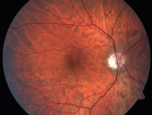 Optic Nerve Hypoplasia - 43 Year Old Man - declining vision
43-year-old man was diagnosed with optic nerve hypoplasia at age fifteen at the National Institute of Health.  His vision seems to be declining lately.
Vision OD is 20/80, OS is 20/120
