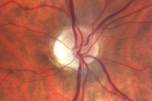 Optic Nerve Hypoplasia - 43 Year Old Man - declining vision
43-year-old man was diagnosed with optic nerve hypoplasia at age fifteen at the National Institute of Health.  His vision seems to be declining lately.
Vision OD is 20/80, OS is 20/120
