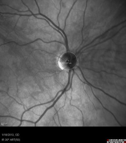 Optic Nerve Hypoplasia - 43 Year Old Man - declining vision
43-year-old man was diagnosed with optic nerve hypoplasia at age fifteen at the National Institute of Health.  His vision seems to be declining lately.
Vision OD is 20/80, OS is 20/120
