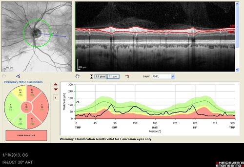 Optic Nerve Hypoplasia - 43 Year Old Man - declining vision
43-year-old man was diagnosed with optic nerve hypoplasia at age fifteen at the National Institute of Health.  His vision seems to be declining lately.
Vision OD is 20/80, OS is 20/120
