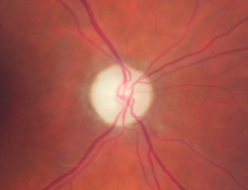 Three years after Injury - Optic Atrophy - Vision is 1/200 in each eye
