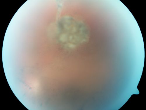 Post Macula Retinal Detachment Repair  On Pneumatic Retinopexy and subsequent Scleral Buckle Vitreous Opacity (No Vitrectomy)
55-year-old man had a scleral buckle for a macula-threatening retinal detachment in the left eye one month ago and a previous pneumatic retinopexy.  Patient sees a big floater. His vision is improving.

VISUAL ACUITY:  Vision OS is 20/50
