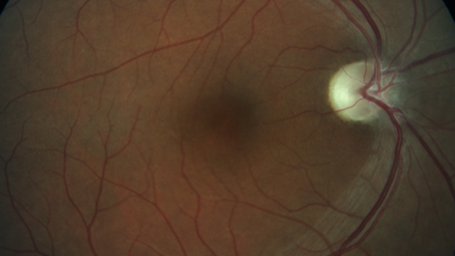 Temporal Pallor - Optic Atrophy - Multiple Sclerosis
42 year old man - Starting about 2 weeks ago he noticed when coming in from walking a dog from bright to dark and when looking at a piece of mail there was a yellow outline on the text that would only last for a few minutes.  The patient has been legally blind for about 6-7 years.  He is legally blind from MS.  
VA OD: DccCF 4ft NccJ16
VA OS: Dcc20/200 PHNI NccJ16
IOP: TP: OD:17 OS:14
