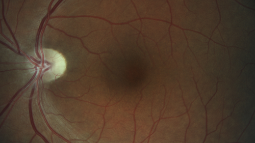 Temporal Pallor - Optic Atrophy - Multiple Sclerosis
42 year old man - Starting about 2 weeks ago he noticed when coming in from walking a dog from bright to dark and when looking at a piece of mail there was a yellow outline on the text that would only last for a few minutes.  The patient has been legally blind for about 6-7 years.  He is legally blind from MS.  
VA OD: DccCF 4ft NccJ16
VA OS: Dcc20/200 PHNI NccJ16
IOP: TP: OD:17 OS:14
