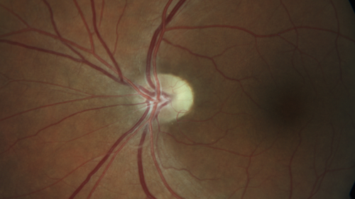 Temporal Pallor - Optic Atrophy - Multiple Sclerosis
42 year old man - Starting about 2 weeks ago he noticed when coming in from walking a dog from bright to dark and when looking at a piece of mail there was a yellow outline on the text that would only last for a few minutes.  The patient has been legally blind for about 6-7 years.  He is legally blind from MS.  
VA OD: DccCF 4ft NccJ16
VA OS: Dcc20/200 PHNI NccJ16
IOP: TP: OD:17 OS:14
