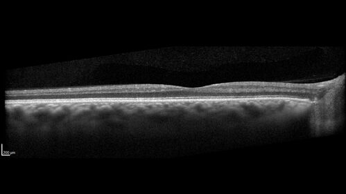 Temporal Pallor - Optic Atrophy - Multiple Sclerosis
42 year old man - Starting about 2 weeks ago he noticed when coming in from walking a dog from bright to dark and when looking at a piece of mail there was a yellow outline on the text that would only last for a few minutes.  The patient has been legally blind for about 6-7 years.  He is legally blind from MS.  
VA OD: DccCF 4ft NccJ16
VA OS: Dcc20/200 PHNI NccJ16
IOP: TP: OD:17 OS:14
