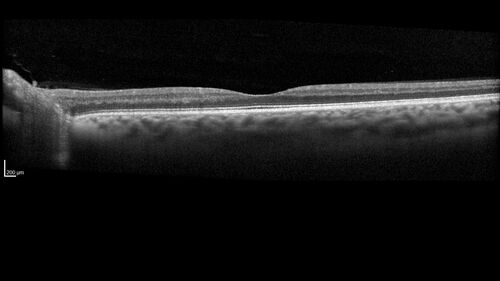 Temporal Pallor - Optic Atrophy - Multiple Sclerosis
42 year old man - Starting about 2 weeks ago he noticed when coming in from walking a dog from bright to dark and when looking at a piece of mail there was a yellow outline on the text that would only last for a few minutes.  The patient has been legally blind for about 6-7 years.  He is legally blind from MS.  
VA OD: DccCF 4ft NccJ16
VA OS: Dcc20/200 PHNI NccJ16
IOP: TP: OD:17 OS:14
