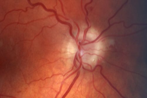 Optic Nerve Hypoplasia
28-year-old man with diabetes and anomalous vessels near nerve. OD is 20/25, OS is 20/20.  IOP:  OD 20, OS 22.
OD:  Vertical C/D ratio is 0.0.  The nerve is tilted and small and there is an anomalous branching pattern of the major retinal vessels.  There is a tuft of irregular telangiectatic vessels on the nasal edge of the optic nerve.  There is also a buried optic nerve druse at the optic margin at 5:00 oâ€™clock.  There are rare retinal hemorrhages in the macula.
OS:   Vertical C/D ratio is 0.0.  Again, the  nerve looks small.  There is an anomalous branching pattern of the retinal vessels and rare retinal hemorrhages. 
