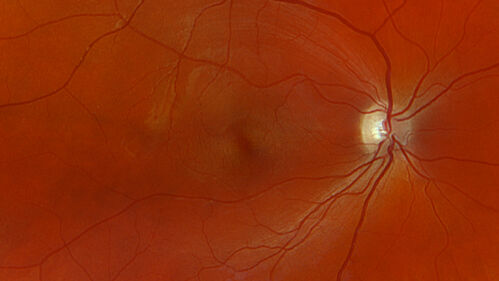 Optic Neuritis sentinel event for MS (23 year old female)
23-year-old female contact lens wearer reports recurrent blurry vision with a central 