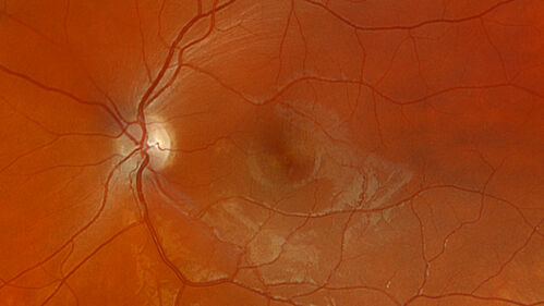 Optic Neuritis sentinel event for MS (23 year old female)
23-year-old female contact lens wearer reports recurrent blurry vision with a central 