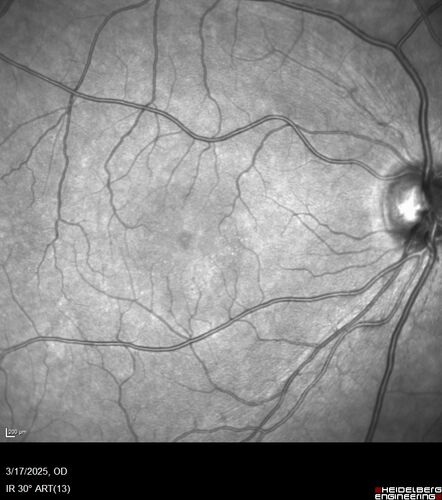 Optic Neuritis sentinel event for MS (23 year old female)
23-year-old female contact lens wearer reports recurrent blurry vision with a central 