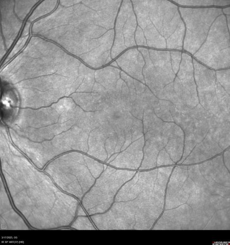 Optic Neuritis sentinel event for MS (23 year old female)
23-year-old female contact lens wearer reports recurrent blurry vision with a central 