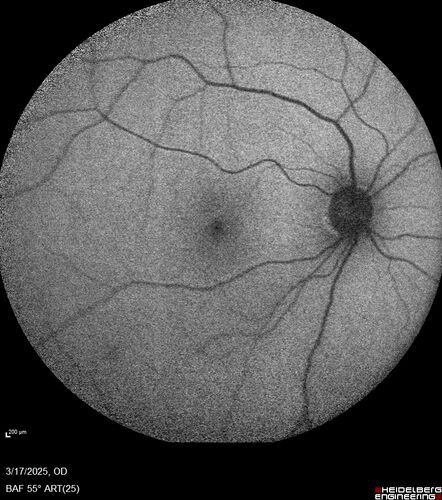 Optic Neuritis sentinel event for MS (23 year old female)
23-year-old female contact lens wearer reports recurrent blurry vision with a central 