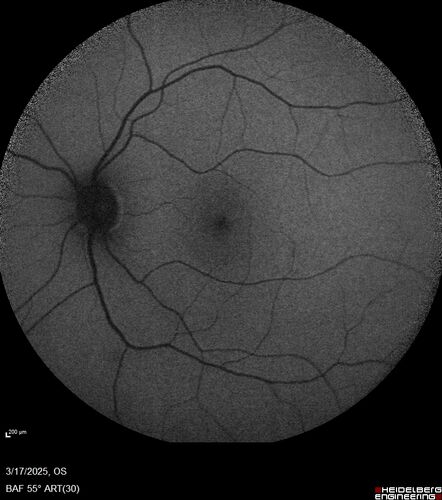 Optic Neuritis sentinel event for MS (23 year old female)
23-year-old female contact lens wearer reports recurrent blurry vision with a central 