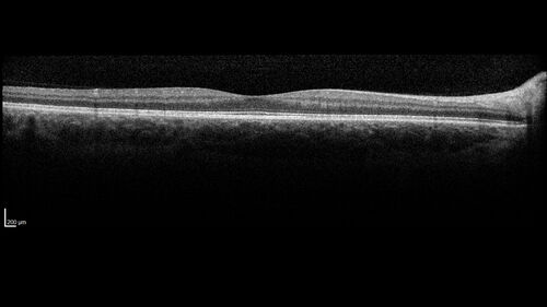Optic Neuritis sentinel event for MS (23 year old female)
23-year-old female contact lens wearer reports recurrent blurry vision with a central 