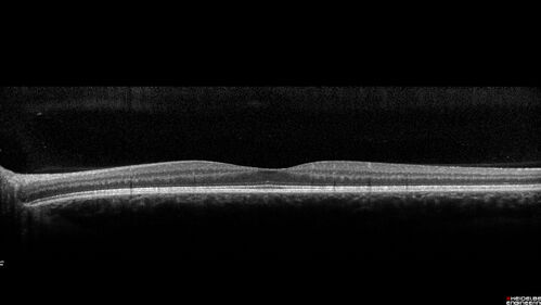 Optic Neuritis sentinel event for MS (23 year old female)
23-year-old female contact lens wearer reports recurrent blurry vision with a central 