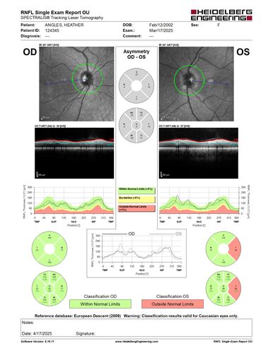 Optic Neuritis sentinel event for MS (23 year old female)
23-year-old female contact lens wearer reports recurrent blurry vision with a central 