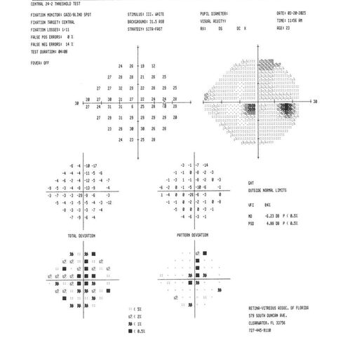 Optic Neuritis sentinel event for MS (23 year old female)
23-year-old female contact lens wearer reports recurrent blurry vision with a central 