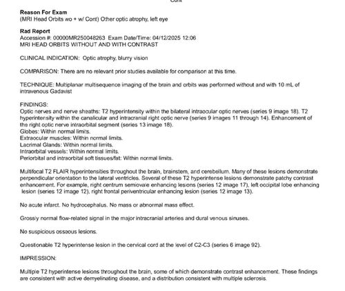 Optic Neuritis sentinel event for MS (23 year old female)
23-year-old female contact lens wearer reports recurrent blurry vision with a central 