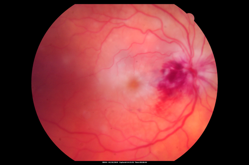 Orbital Cellulitis - Optic nerve compression with ocular ischemia
81 year old woman with constricted eye movement, orbital cellulitis and severe vision loss in the right eye (LP).  She has whitening of the retina and the OCT shows ischemic changes as well as subretinal fluid and blood.  The vision in this eye declined to NLP and the eye remained ischemic despite control of her infection.

