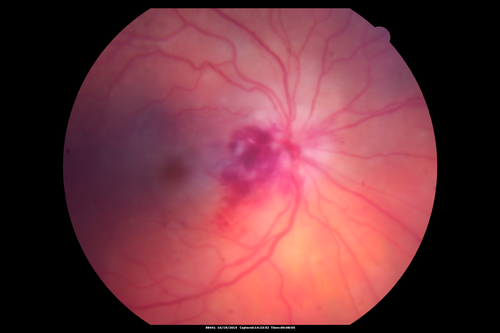 Orbital Cellulitis - Optic nerve compression with ocular ischemia
81 year old woman with constricted eye movement, orbital cellulitis and severe vision loss in the right eye (LP).  She has whitening of the retina and the OCT shows ischemic changes as well as subretinal fluid and blood.  The vision in this eye declined to NLP and the eye remained ischemic despite control of her infection.
