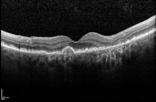 Orbital Cellulitis - Optic nerve compression with ocular ischemia
81 year old woman with constricted eye movement, orbital cellulitis and severe vision loss in the right eye (LP).  She has whitening of the retina and the OCT shows ischemic changes as well as subretinal fluid and blood.  The vision in this eye declined to NLP and the eye remained ischemic despite control of her infection.
