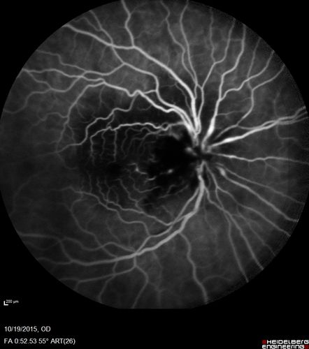 Orbital Cellulitis - Optic nerve compression with ocular ischemia
81 year old woman with constricted eye movement, orbital cellulitis and severe vision loss in the right eye (LP).  She has whitening of the retina and the OCT shows ischemic changes as well as subretinal fluid and blood.  The vision in this eye declined to NLP and the eye remained ischemic despite control of her infection.

