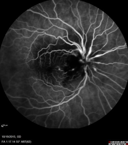 Orbital Cellulitis - Optic nerve compression with ocular ischemia
81 year old woman with constricted eye movement, orbital cellulitis and severe vision loss in the right eye (LP).  She has whitening of the retina and the OCT shows ischemic changes as well as subretinal fluid and blood.  The vision in this eye declined to NLP and the eye remained ischemic despite control of her infection.
