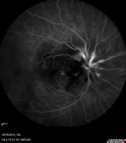 Orbital Cellulitis - Optic nerve compression with ocular ischemia
81 year old woman with constricted eye movement, orbital cellulitis and severe vision loss in the right eye (LP).  She has whitening of the retina and the OCT shows ischemic changes as well as subretinal fluid and blood.  The vision in this eye declined to NLP and the eye remained ischemic despite control of her infection.
