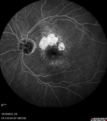 Orbital Cellulitis - Optic nerve compression with ocular ischemia
81 year old woman with constricted eye movement, orbital cellulitis and severe vision loss in the right eye (LP).  She has whitening of the retina and the OCT shows ischemic changes as well as subretinal fluid and blood.  The vision in this eye declined to NLP and the eye remained ischemic despite control of her infection.
