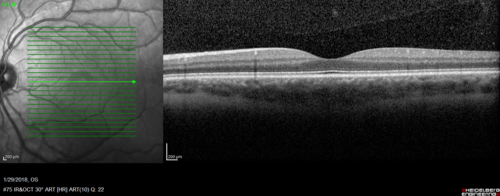 osteoma (14)
