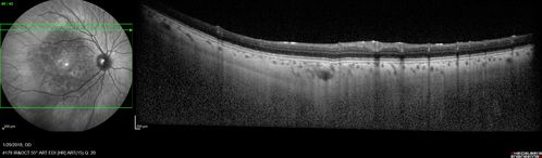 osteoma (2)
