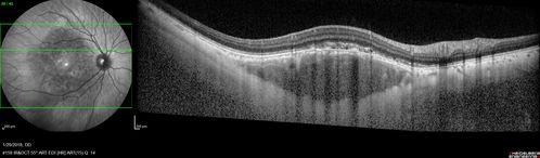 osteoma (3)
