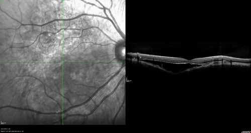 Choroidal Osteoma 13 Year Old
13 year old with 6 months of vision loss right eye and vision of 20/40
