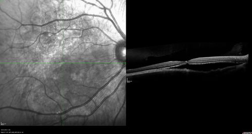 Choroidal Osteoma 13 Year Old
13 year old with 6 months of vision loss right eye and vision of 20/40
