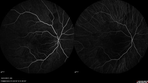 Choroidal Osteoma 13 Year Old
13 year old with 6 months of vision loss right eye and vision of 20/40
