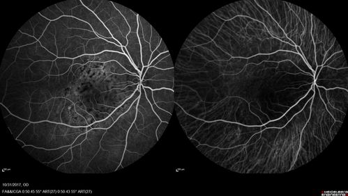 Choroidal Osteoma 13 Year Old
13 year old with 6 months of vision loss right eye and vision of 20/40
