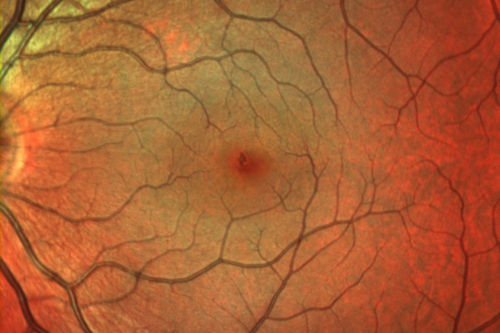 Outer Retinal Holes - Probably Solar Retinopathy (history is negative)
