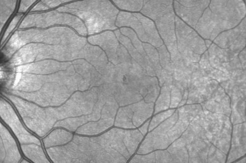 Outer Retinal Holes - Probably Solar Retinopathy (history is negative)
