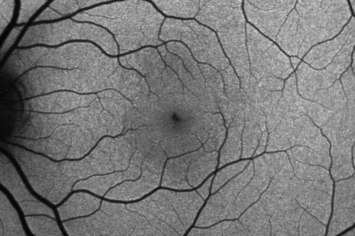 Outer Retinal Holes - Probably Solar Retinopathy (history is negative)
