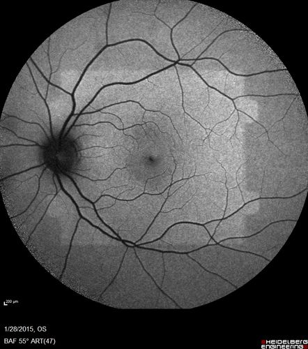 Outer Retinal Holes - Probably Solar Retinopathy (history is negative)
