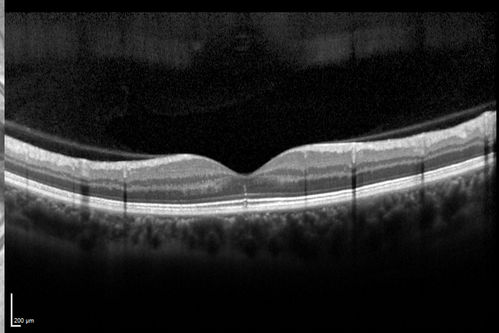 Outer Retinal Holes - Probably Solar Retinopathy (history is negative)
