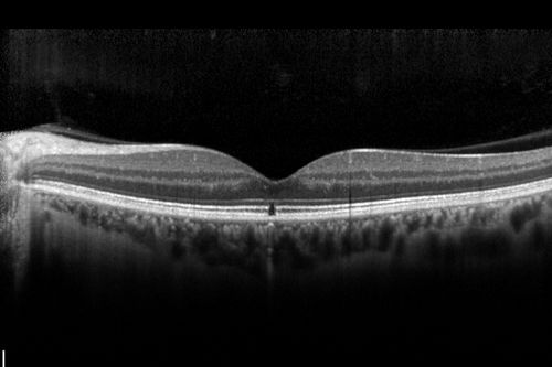 Outer Retinal Holes - Probably Solar Retinopathy (history is negative)
