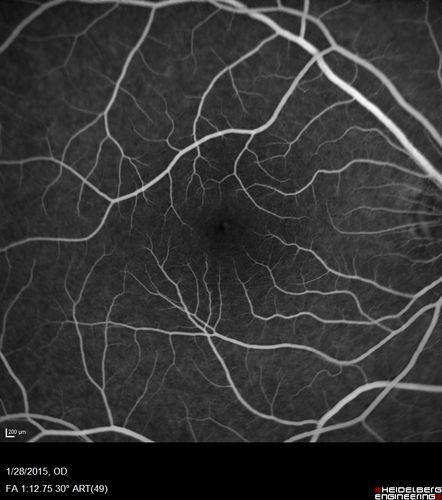 Outer Retinal Holes - Probably Solar Retinopathy (history is negative)
