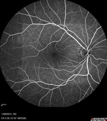 Outer Retinal Holes - Probably Solar Retinopathy (history is negative)
