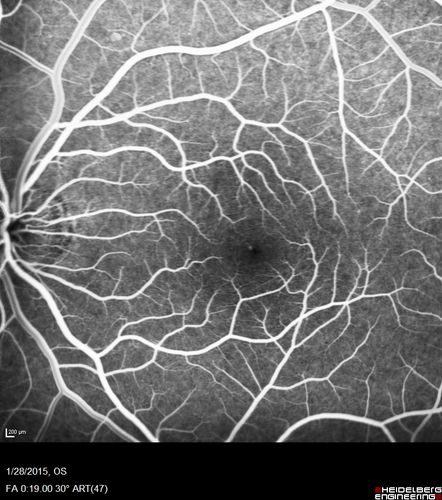 Outer Retinal Holes - Probably Solar Retinopathy (history is negative)
