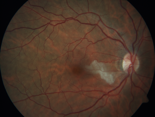 Cardiac Catheterization induced Cilioretinal Artery Occlusion - Paracentral Acute Middle Maculopathy
69 year old female with sudden vision loss on completing cardiac catheterization.  The SD OCT shows a PAMM lesion and the lesion looks gray on color imaging.  There is delayed filling of the cilioretinal artery.
