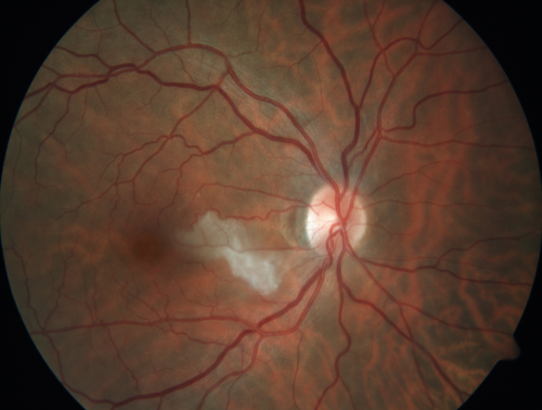 Cardiac Catheterization induced Cilioretinal Artery Occlusion - Paracentral Acute Middle Maculopathy
69 year old female with sudden vision loss on completing cardiac catheterization.  The SD OCT shows a PAMM lesion and the lesion looks gray on color imaging.  There is delayed filling of the cilioretinal artery.
