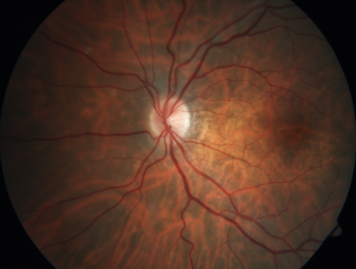 Cardiac Catheterization induced Cilioretinal Artery Occlusion - Paracentral Acute Middle Maculopathy
69 year old female with sudden vision loss on completing cardiac catheterization.  The SD OCT shows a PAMM lesion and the lesion looks gray on color imaging.  There is delayed filling of the cilioretinal artery.
